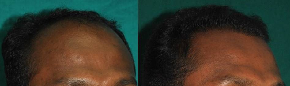 Best hair transplant result in Kerala